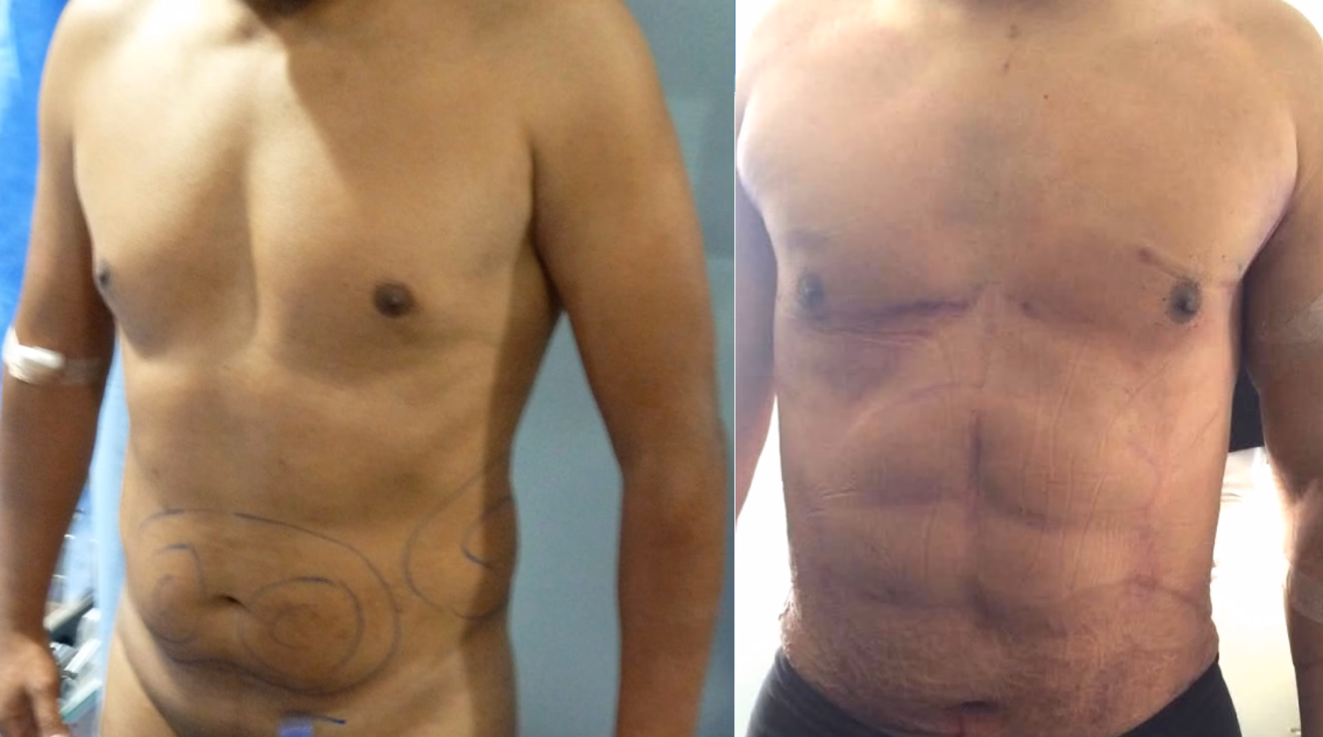 ¿Qué es la cirugía plástica Vaser?